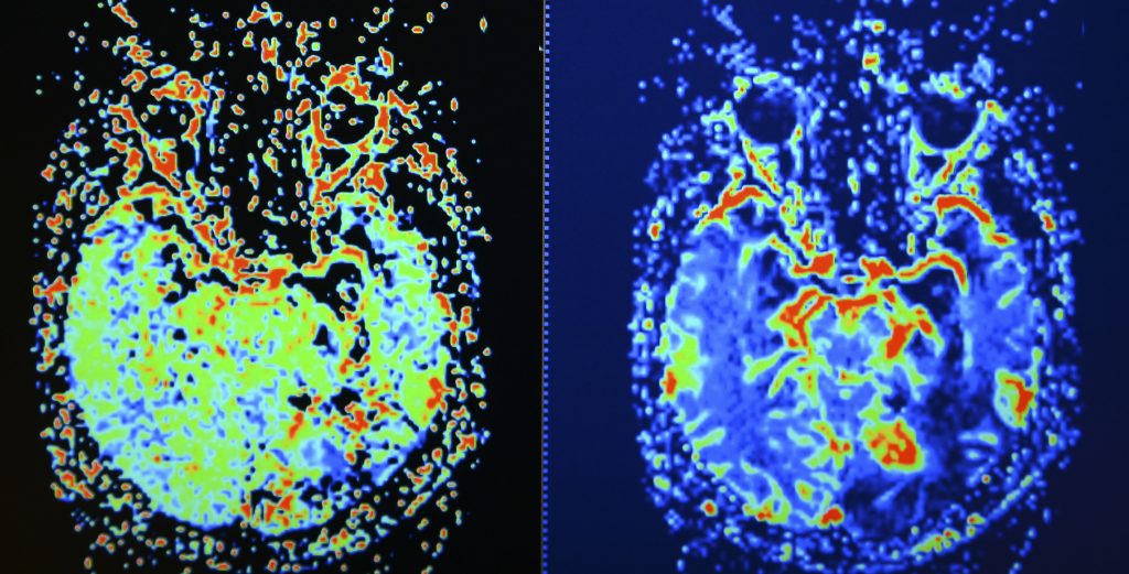 PTSD, brain scan, mri