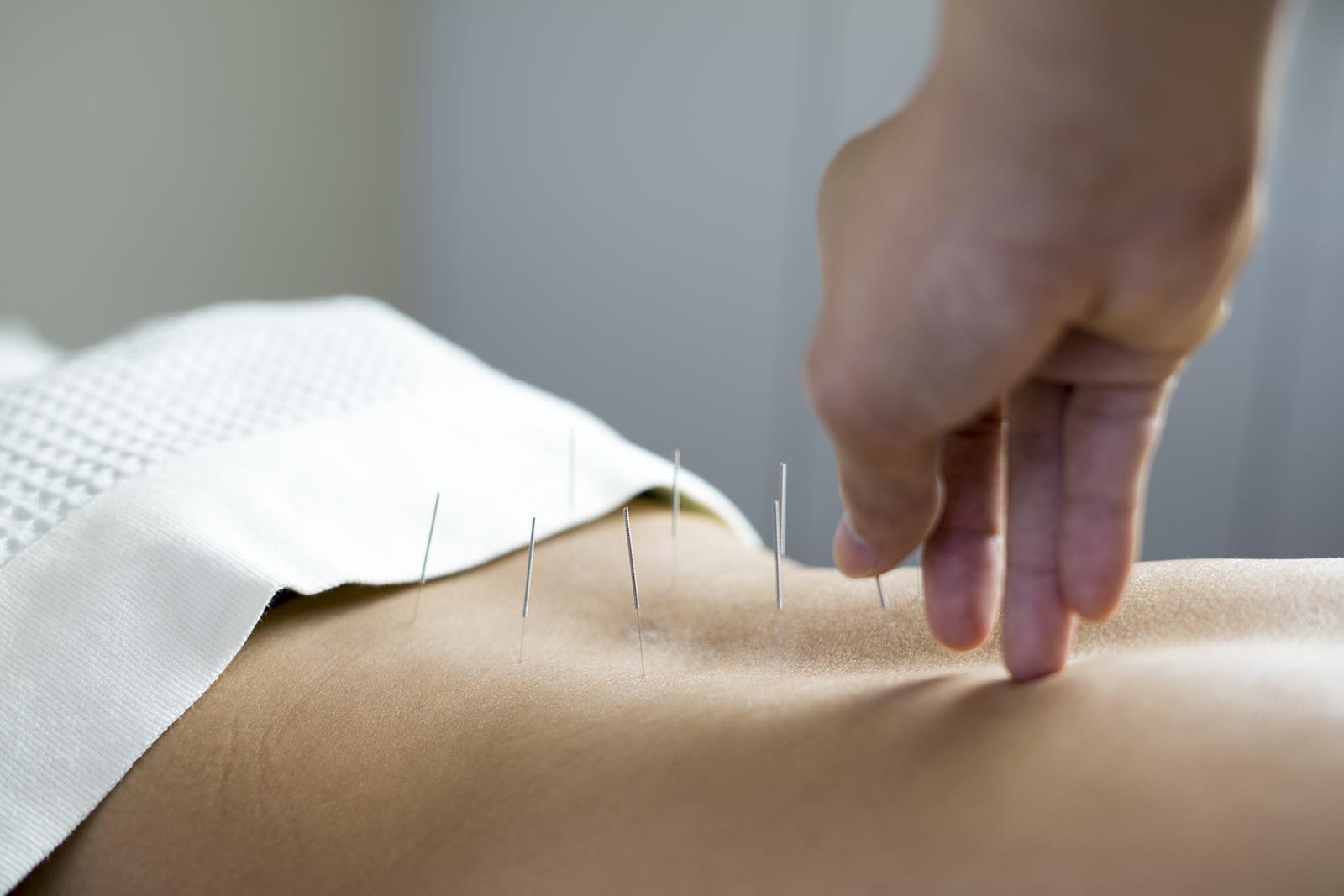 Acupuncture at Cliffside Malibu, an addiction treatment center in Malibu, California.